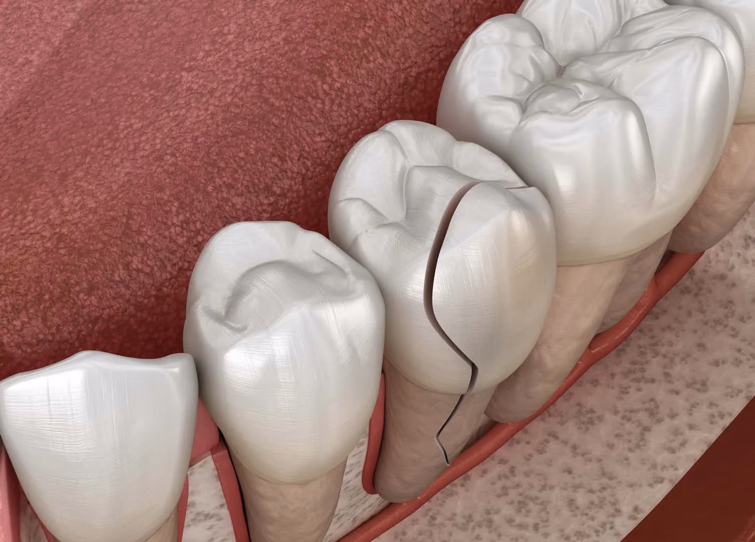 Cracked Teeth Treatment